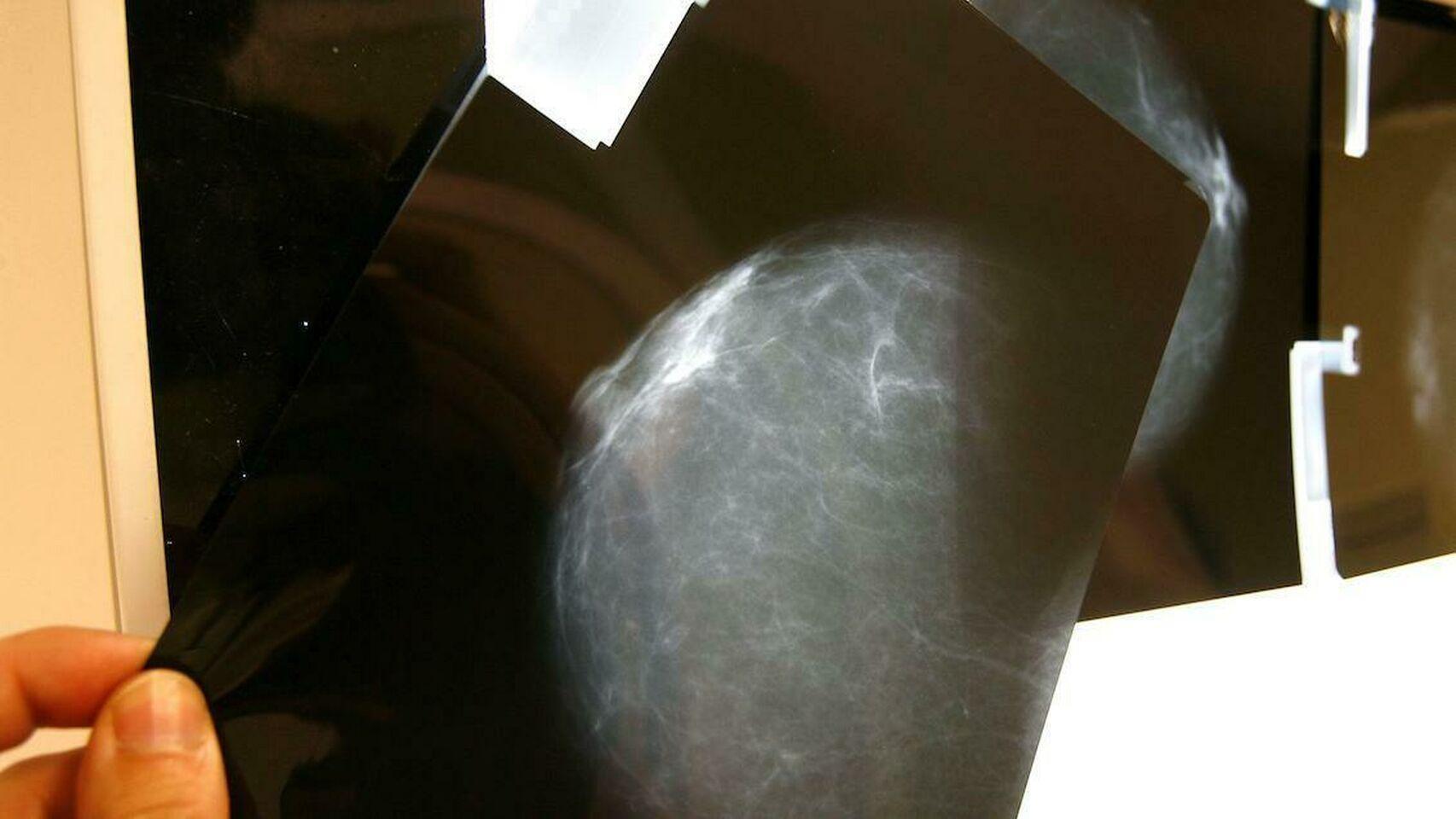 Condena a la ginecóloga que detectó un cáncer de mama con 5 meses de retraso 